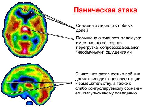 Процессы в головном мозге при панической атаке