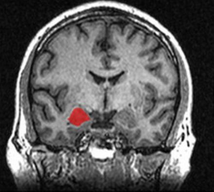 Миндалевидное тело. 