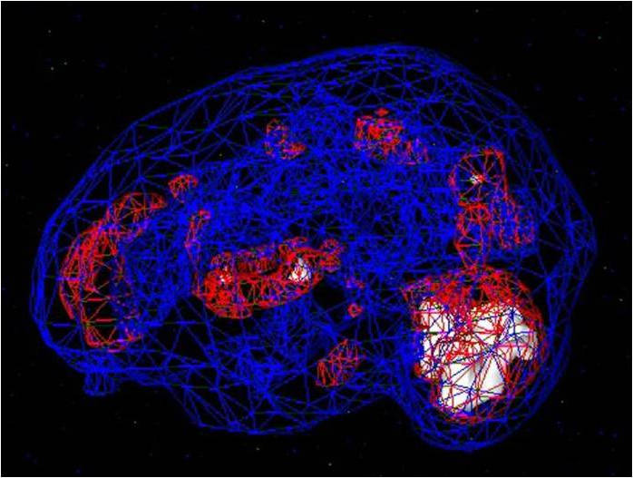overactive-emotional-brain-MRT-sociophobia